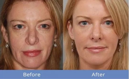Hình ảnh đã được Before After